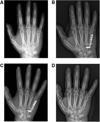 The long-term curative effect analysis of trans-articular plate combined with Kirschner wires in the treatment of fracture-dislocation of the fifth carpometacarpal joint